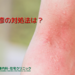 じんましんの対処法
