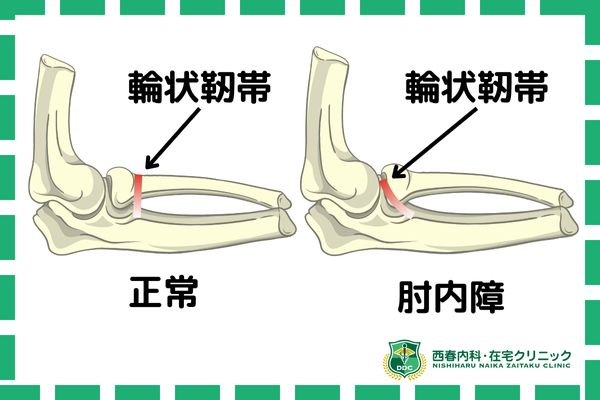 肘内障